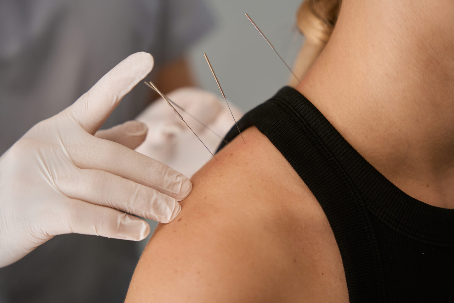 acupuncturist with glove inserting needle into a woman's shoulder