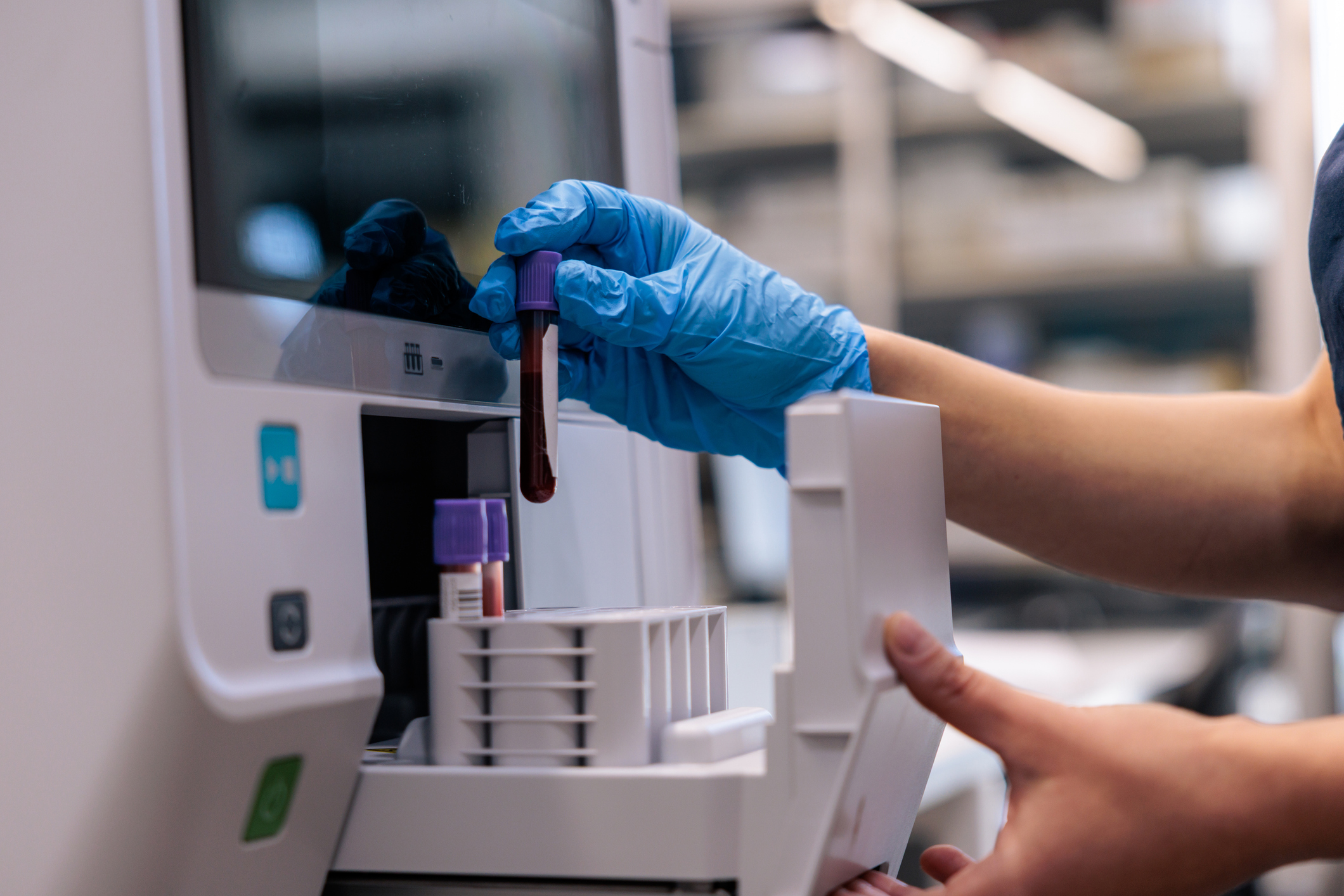 What a normal CA-125 range means with an ovarian cancer diagnosis